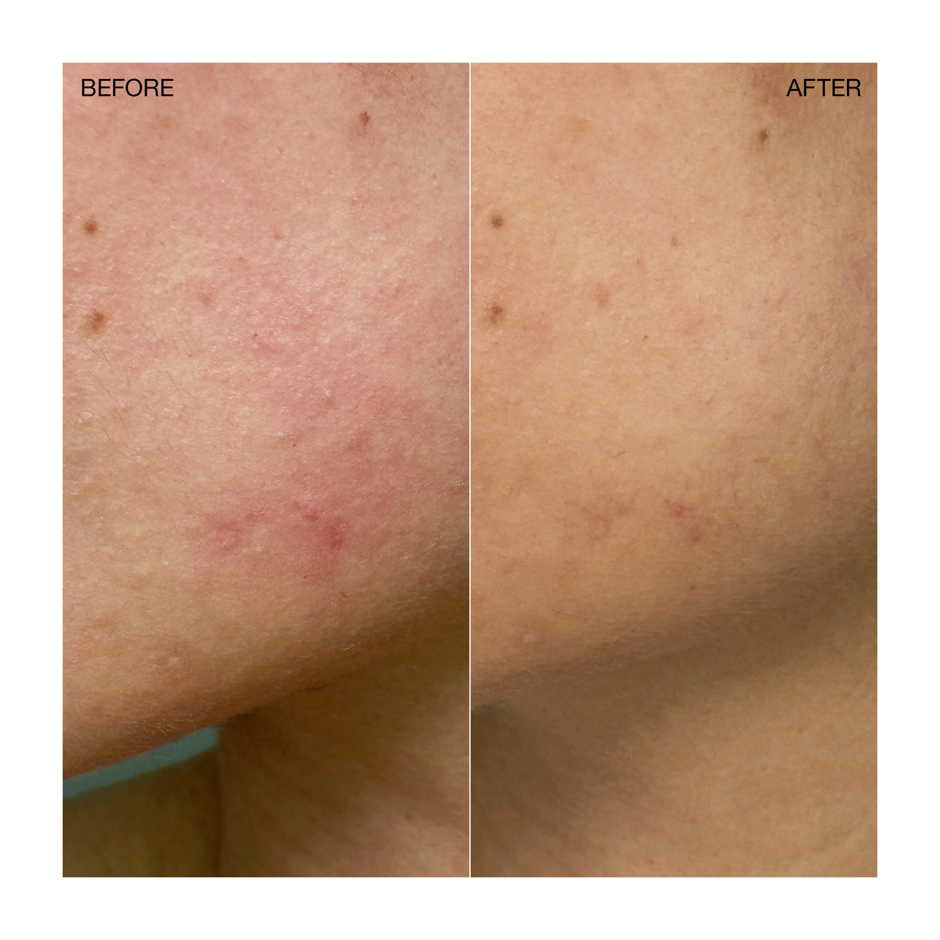 Targeted Blemish Treatment - Image 5